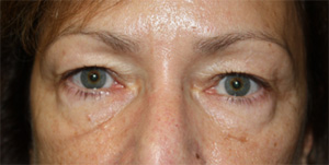 Blepharoplasty Before & After Patient #25007