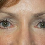 Blepharoplasty Before & After Patient #25007