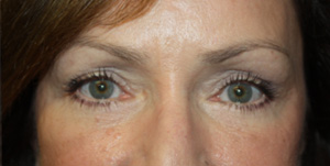 Blepharoplasty Before & After Patient #25007