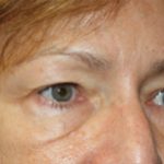 Blepharoplasty Before & After Patient #25007