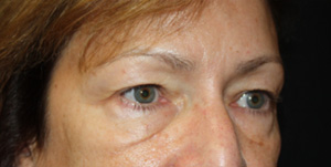 Blepharoplasty Before & After Patient #25007