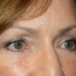 Blepharoplasty Before & After Patient #25007