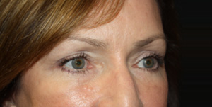 Blepharoplasty Before & After Patient #25007