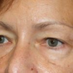 Blepharoplasty Before & After Patient #25007