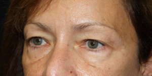 Blepharoplasty Before & After Patient #25007