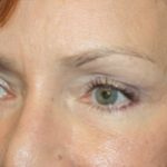 Blepharoplasty Before & After Patient #25007