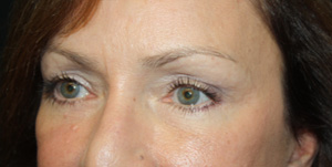 Blepharoplasty Before & After Patient #25007