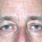 Blepharoplasty Before & After Patient #25008