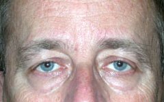Blepharoplasty Before & After Patient #25008