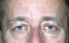 Blepharoplasty Before & After Patient #25008
