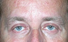 Blepharoplasty Before & After Patient #25008
