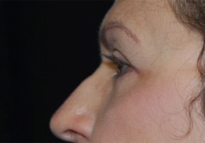 Blepharoplasty Before & After Patient #24901