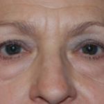 Blepharoplasty Before & After Patient #24901