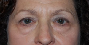 Blepharoplasty Before & After Patient #24901