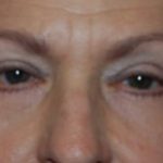 Blepharoplasty Before & After Patient #24901