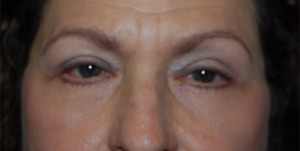 Blepharoplasty Before & After Patient #24901