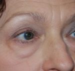 Blepharoplasty Before & After Patient #24901