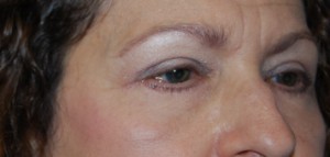 Blepharoplasty Before & After Patient #24901