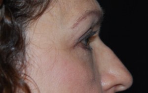 Blepharoplasty Before & After Patient #24901