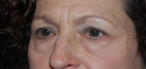 Blepharoplasty Before & After Patient #24901