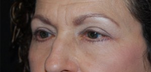 Blepharoplasty Before & After Patient #24901