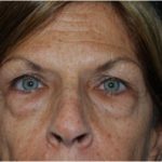 Blepharoplasty Before & After Patient #24923