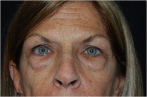 Blepharoplasty Before & After Patient #24923