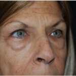 Blepharoplasty Before & After Patient #24923