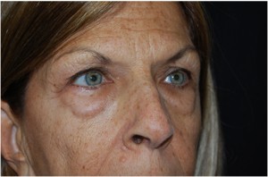 Blepharoplasty Before & After Patient #24923