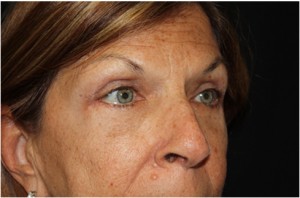 Blepharoplasty Before & After Patient #24923