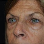 Blepharoplasty Before & After Patient #24923