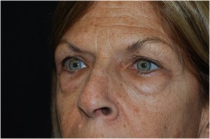 Blepharoplasty Before & After Patient #24923