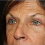 Blepharoplasty Before & After Patient #24923