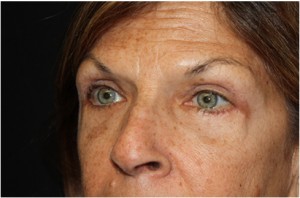 Blepharoplasty Before & After Patient #24923