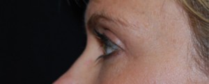 Blepharoplasty Before & After Patient #25017