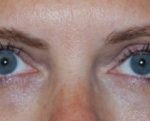 Blepharoplasty Before & After Patient #25017