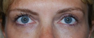 Blepharoplasty Before & After Patient #25017