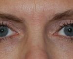 Blepharoplasty Before & After Patient #25017