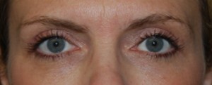 Blepharoplasty Before & After Patient #25017