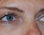 Blepharoplasty Before & After Patient #25017