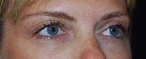 Blepharoplasty Before & After Patient #25017