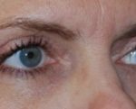 Blepharoplasty Before & After Patient #25017