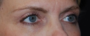 Blepharoplasty Before & After Patient #25017