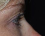 Blepharoplasty Before & After Patient #25017