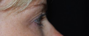 Blepharoplasty Before & After Patient #25017