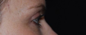 Blepharoplasty Before & After Patient #25017