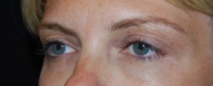 Blepharoplasty Before & After Patient #25017