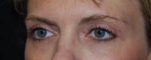 Blepharoplasty Before & After Patient #25017