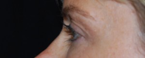 Blepharoplasty Before & After Patient #25017