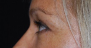 Blepharoplasty Before & After Patient #25022